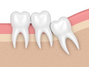 Tooth Extraction Vs Wisdom Tooth Extraction