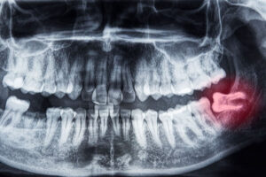 What is Normal Wisdom Tooth Pain