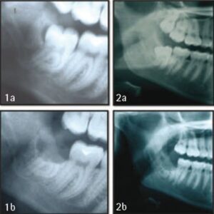 What is a Coronectomy on a Wisdom Tooth