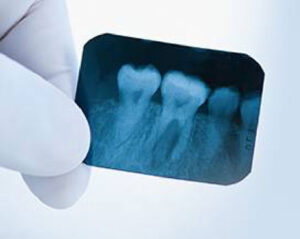 What is the Code for Wisdom Tooth Extraction