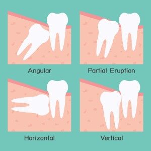 What to Do before Wisdom Tooth Removal