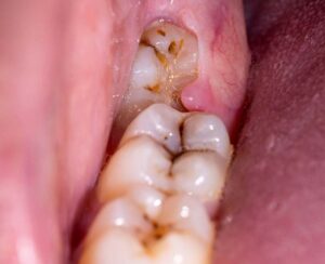 What to Do for Impacted Wisdom Tooth