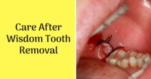When Does Pain Stop After Wisdom Tooth Extraction