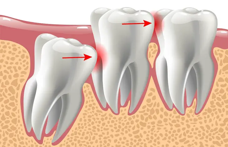 when-does-wisdom-tooth-stop-growing