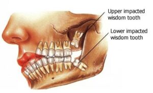 Why is Wisdom Tooth Removal Painful