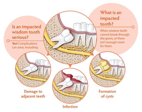 when-should-a-dentist-consider-extracting-a-wisdom-tooth-medshun