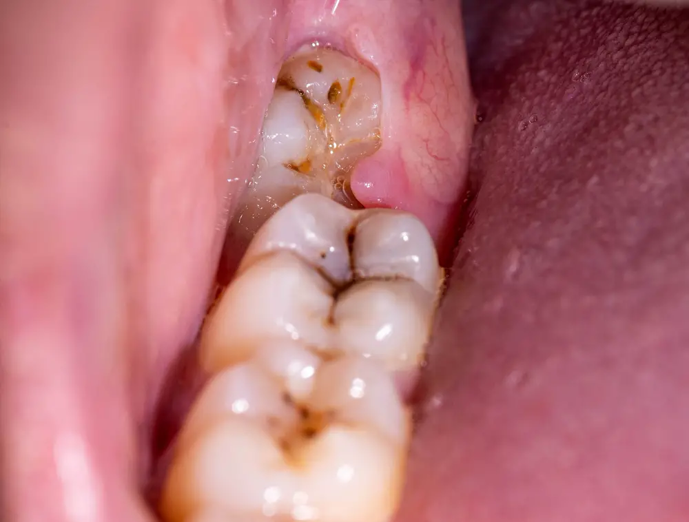 will-wisdom-tooth-gum-flap-go-away