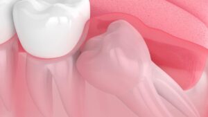 Wisdom Tooth Causing Sinus Problems