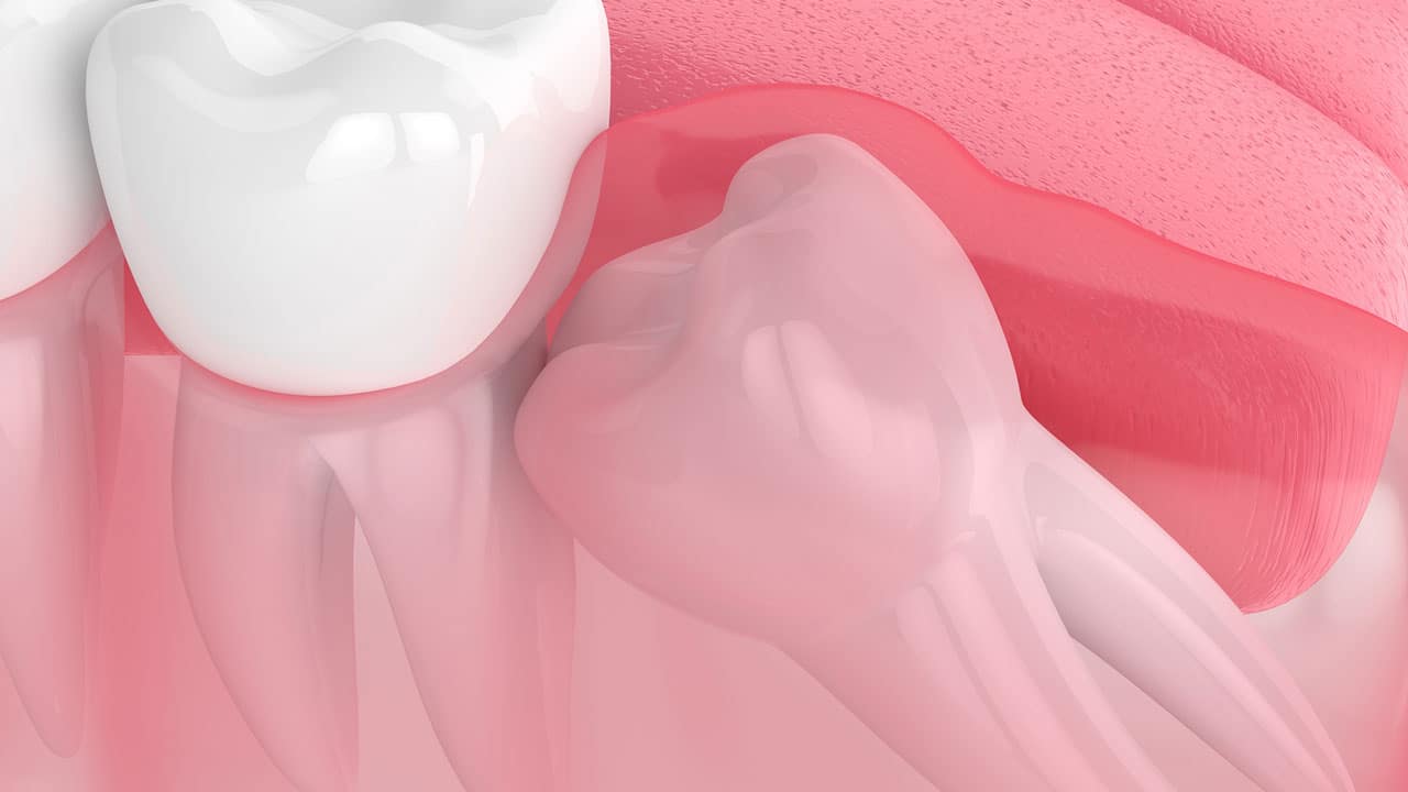 tooth-infection-and-sinusitis-medical-orofacial-surgery