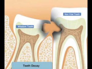 Wisdom Tooth Pain Vs Cavity Pain
