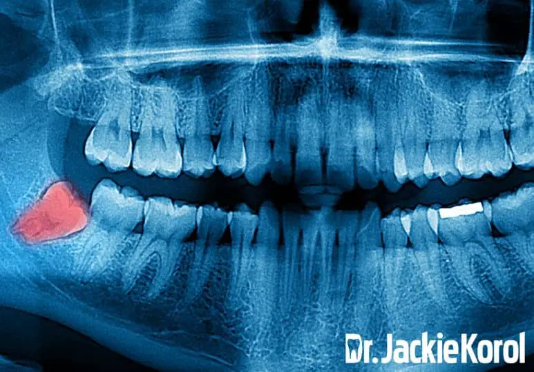 can-wisdom-tooth-cause-neck-pain