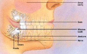 Can You Blow Your Nose After Wisdom Tooth Extraction
