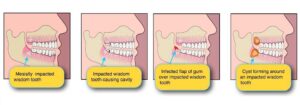 Cavity Vs Wisdom Tooth Pain