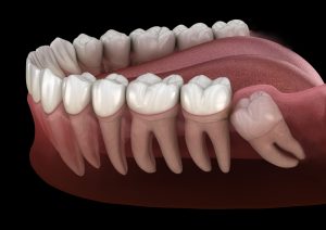 Do Teeth Move After Wisdom Tooth Extraction