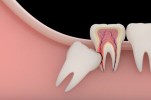 How Common is Wisdom Tooth Removal