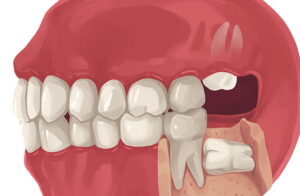 How Much is Wisdom Tooth Removal Without Insurance