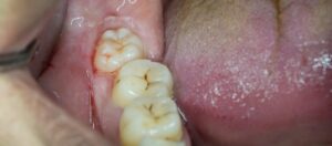 How to Know Wisdom Tooth Pain
