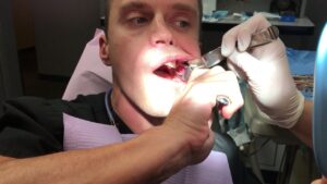 How to Pull Your Own Wisdom Tooth