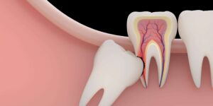 Is Bone Graft Necessary After Wisdom Tooth Extraction