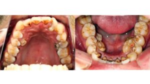 Is It Possible for a Wisdom Tooth to Grow Back