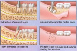 Is Wisdom Tooth Removal Necessary