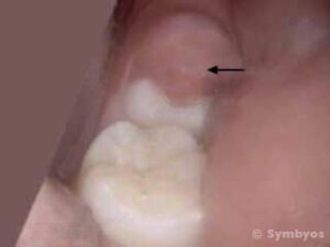 Painful Bump Where Wisdom Tooth was