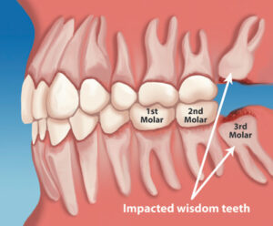 What Age Do You Get Your Wisdom Tooth