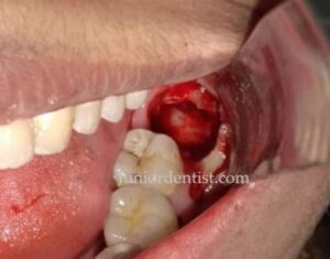 What Does a Healed Wisdom Tooth Look Like