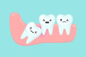 What Happens If You Don’T Remove Wisdom Tooth