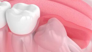 What Happens If Your Wisdom Tooth Falls Out