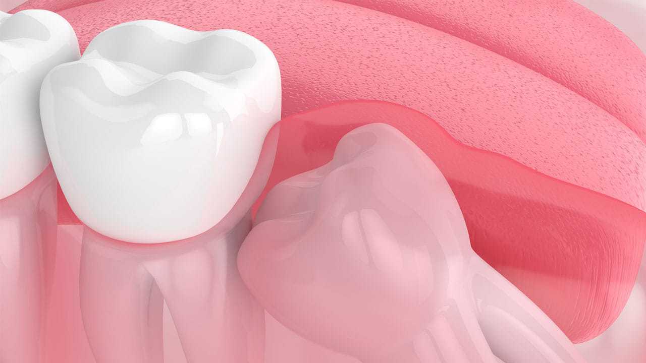 what-happens-if-your-wisdom-tooth-falls-out