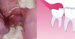 What is an Erupted Wisdom Tooth