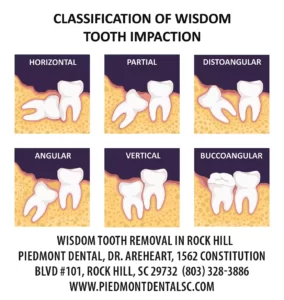 Who Does Wisdom Tooth Extraction