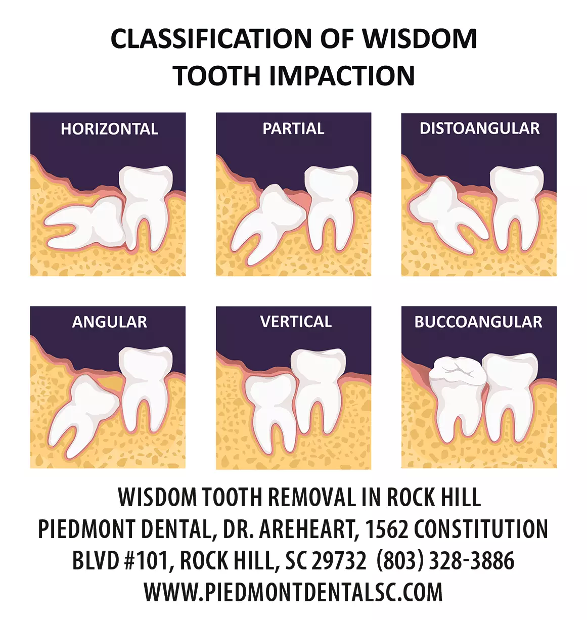 who-does-wisdom-tooth-extraction