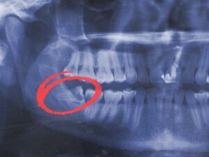 Why is My Wisdom Tooth Growing Sideways