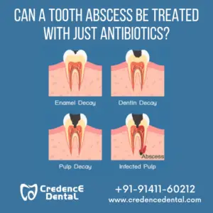 Will Amoxicillin Treat Wisdom Tooth Infection