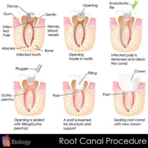 Wisdom Tooth Extraction Or Root Canal Which is Better