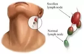 Can Wisdom Tooth Cause Swollen Lymph Nodes