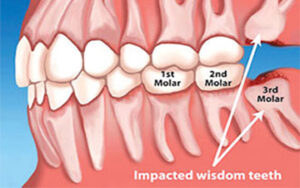 Can Wisdom Tooth Replace Molar