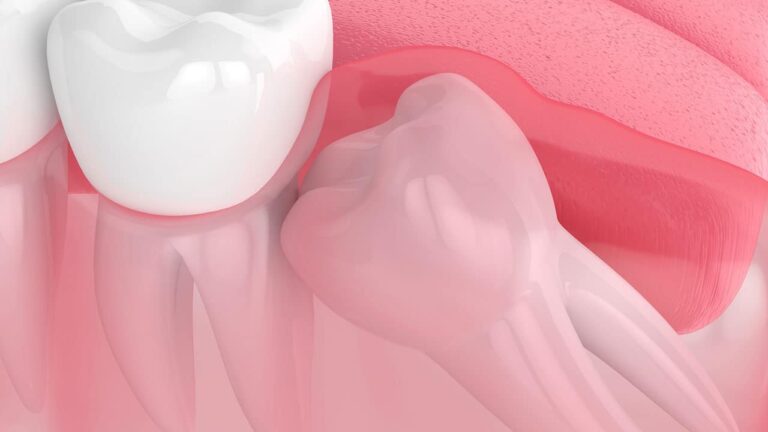 Pain Where Wisdom Tooth Was Removed Years Later