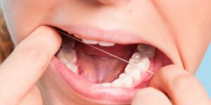 Do You Get Stitches After Wisdom Tooth Removal
