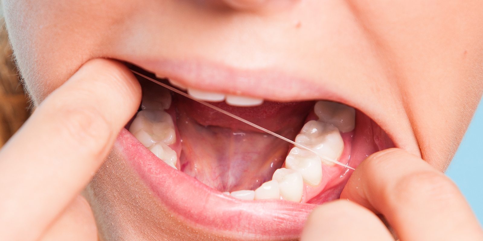 do-you-get-stitches-after-wisdom-tooth-removal