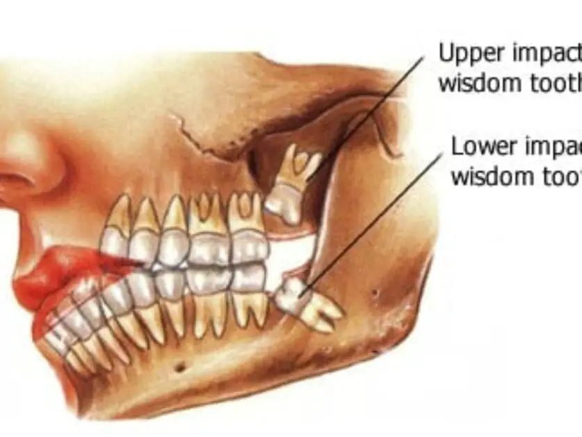 Why Does My Tongue Hurt After Wisdom Tooth Removal