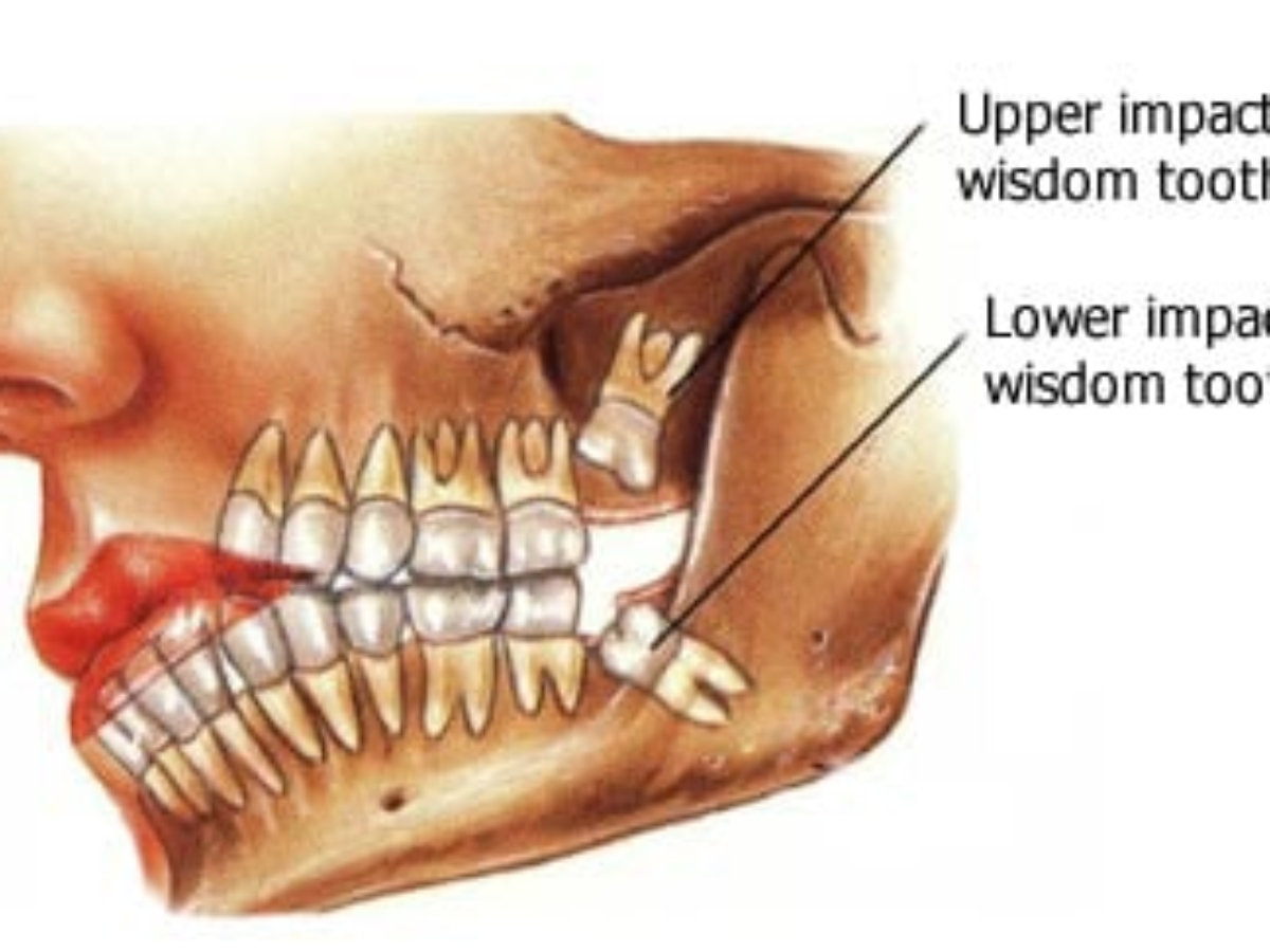 do-you-have-to-get-your-wisdom-tooth-removed