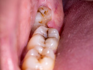 Gum is Growing Over Wisdom Tooth