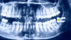 How Long After Wisdom Tooth Extraction Does Pain Last