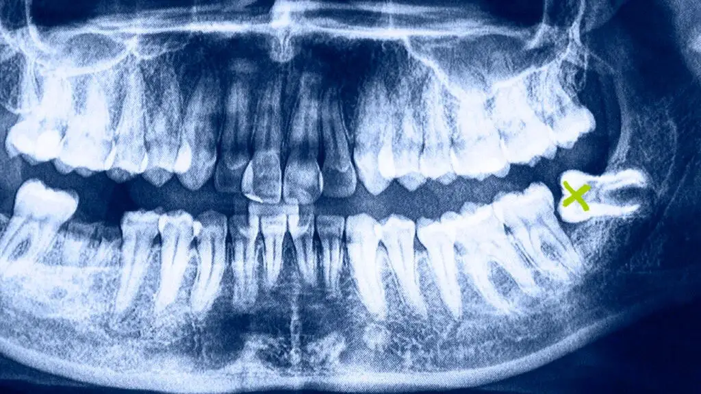 how-long-after-wisdom-tooth-extraction-does-pain-last