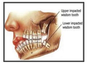 How Long Does It Take a Wisdom Tooth to Heal
