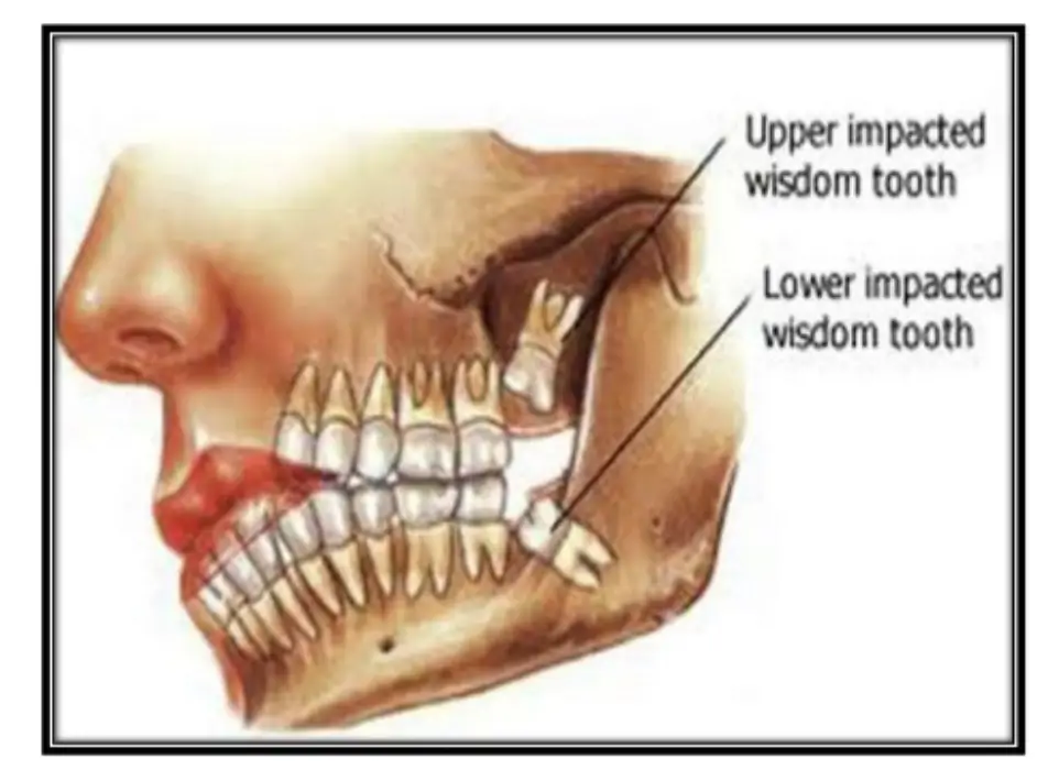 how-long-does-it-take-a-wisdom-tooth-to-heal