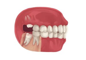 How Long to Recover from Wisdom Tooth Removal